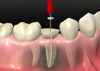 Precision Root Canal Therapy: Saving Your Natural Tooth with Advanced Care